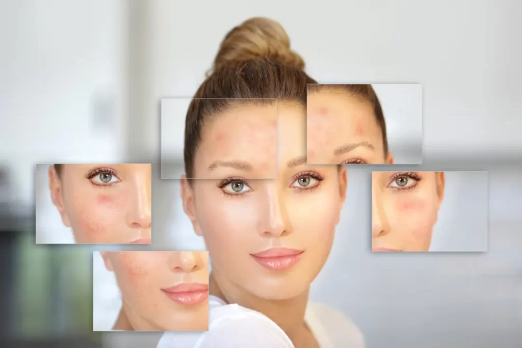 woman using best ingredients for hyperpigmentation
